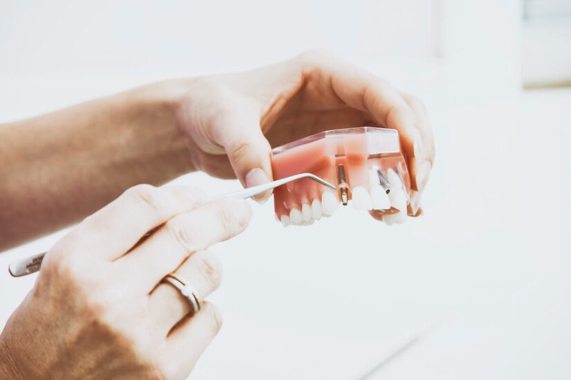 Dentist presenting a dental implant model