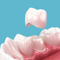 Image for The Power of a Healthy Smile: A Guide to Dental Crowns post