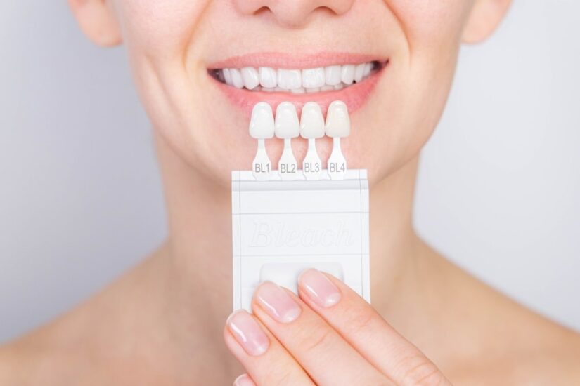 Tooth whitening, perfect white teeth close up with shade guide bleach color, female veneer smile, dental care and stomatology, dentistry