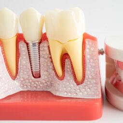 Image for The Modern Solution for Missing Teeth: Understanding Dental Implants post